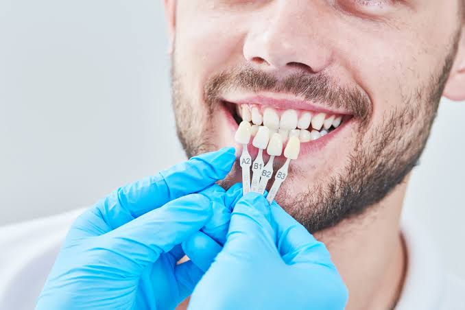 Dental Veneers: A Comprehensive Guide
