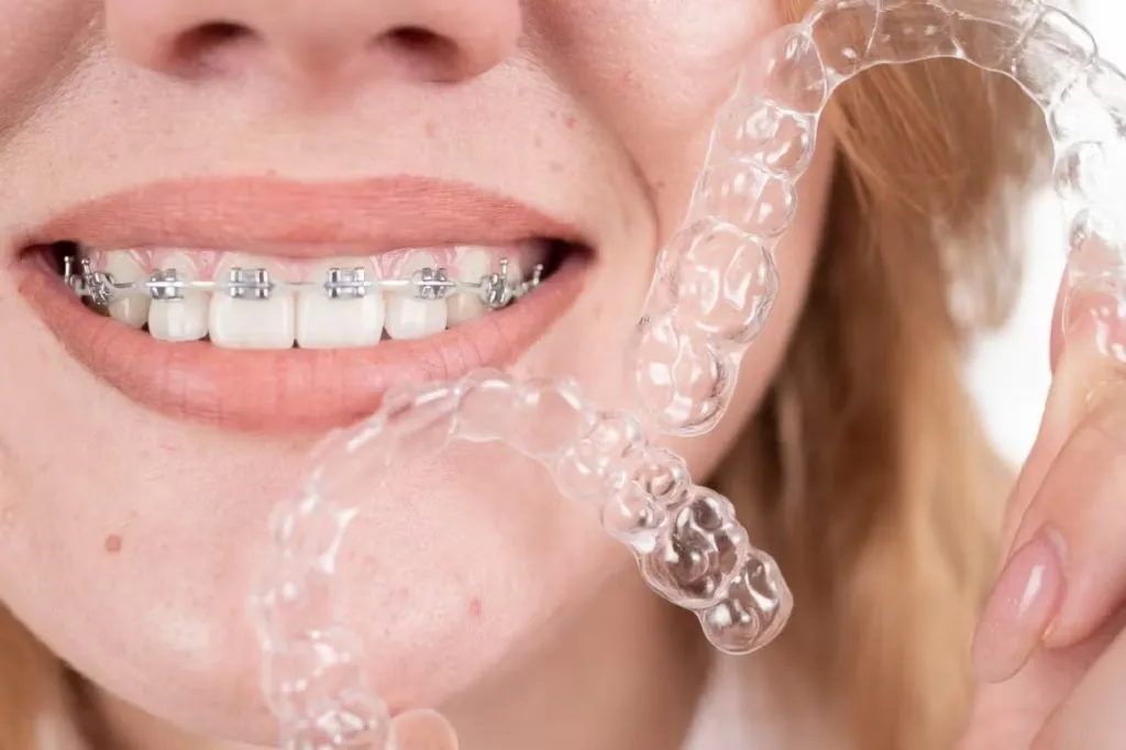 Clear Aligners Vs. Traditional Braces: Pros And Cons