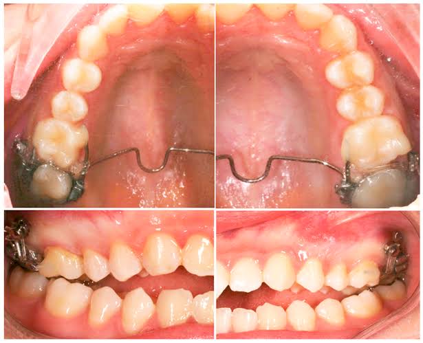 Open Bite Treatment Options: From Habit Appliances To Aligners