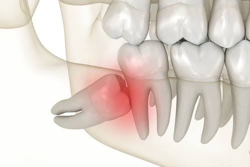 Why Wisdom Tooth Removal Is Best Handled By Oral Surgeons